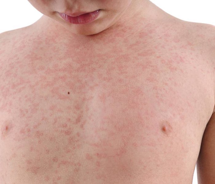 Orticaria nei bambini: come riconoscerla e curarla